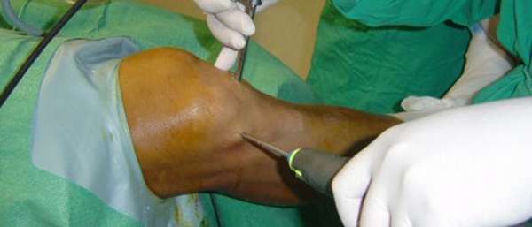 Синовэктомия сустава колена